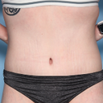 Body Lift Before & After Patient #34335